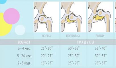 Displasia - una malattia delle articolazioni dell'anca nei bambini Cos'è la displasia congenita